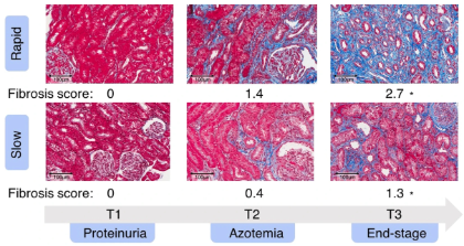 Serial kidney biopsy RNA-seq figure